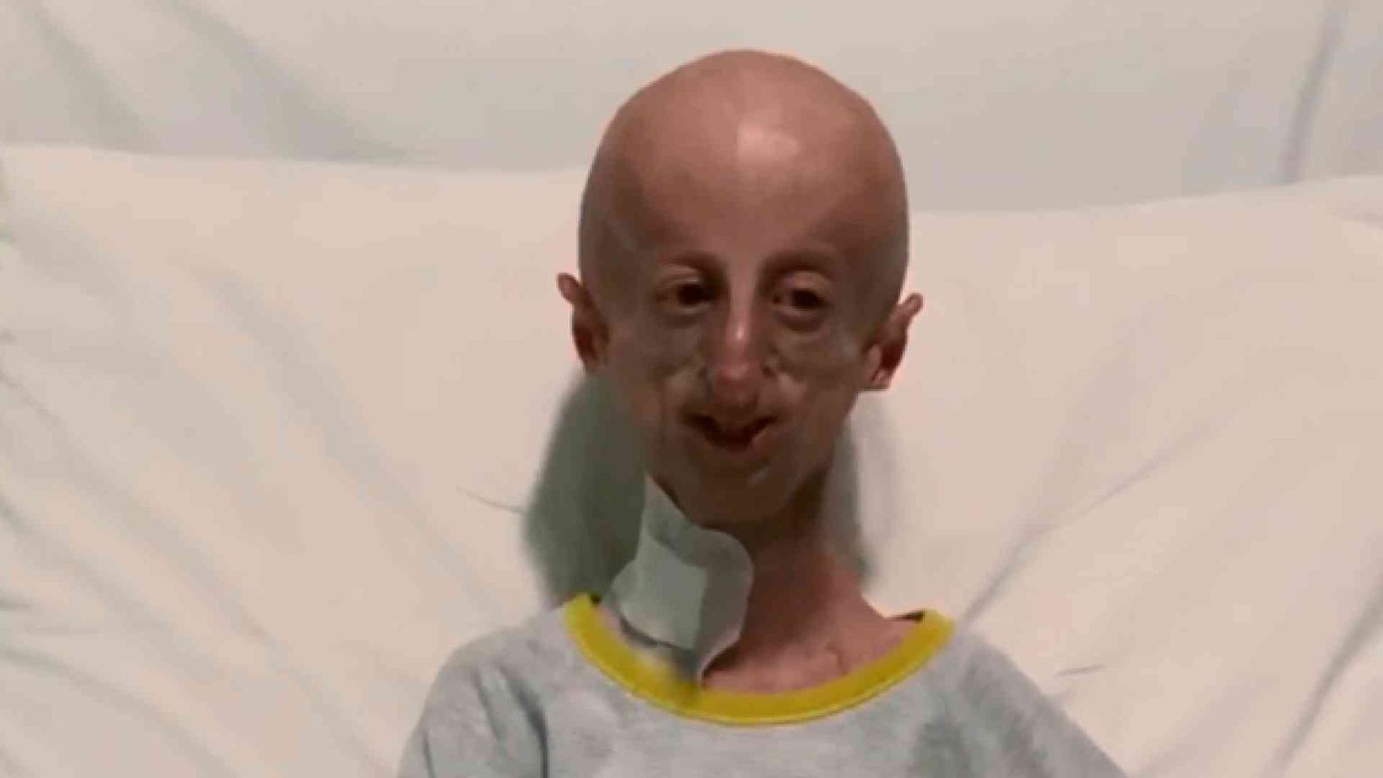 Sammy Basso, malato di progerie, parla dopo l'intervento al cuore