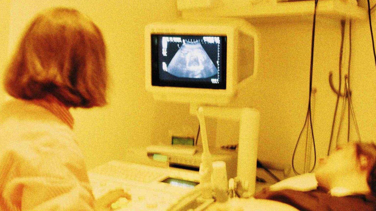 Aborti al minimo, crescono Ru486 e obiezione di coscienza