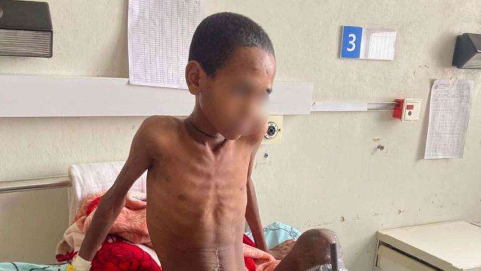 Sos dal Tigrai, aumentano le piccole vittime della fame