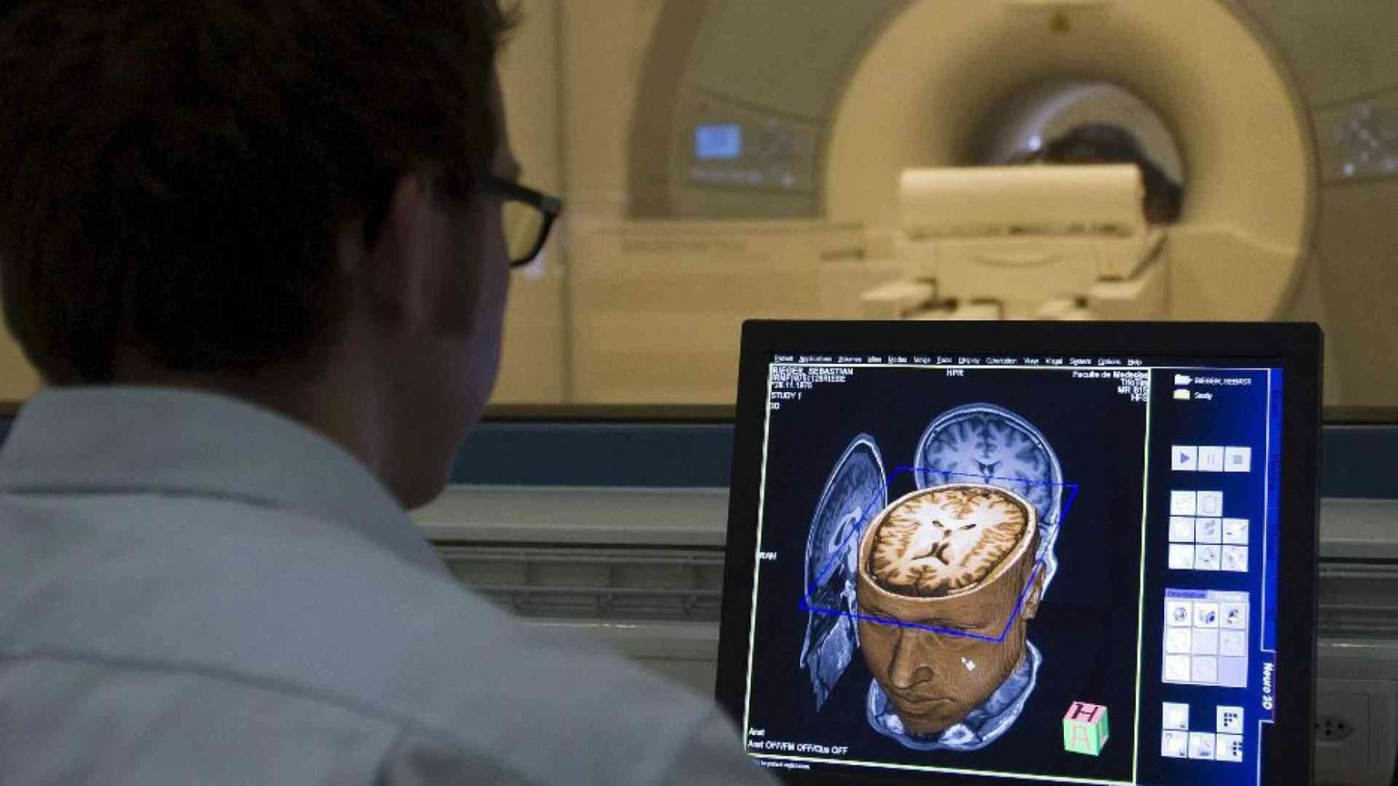 Malato di Sla parla grazie a un lettore collocato nel cervello