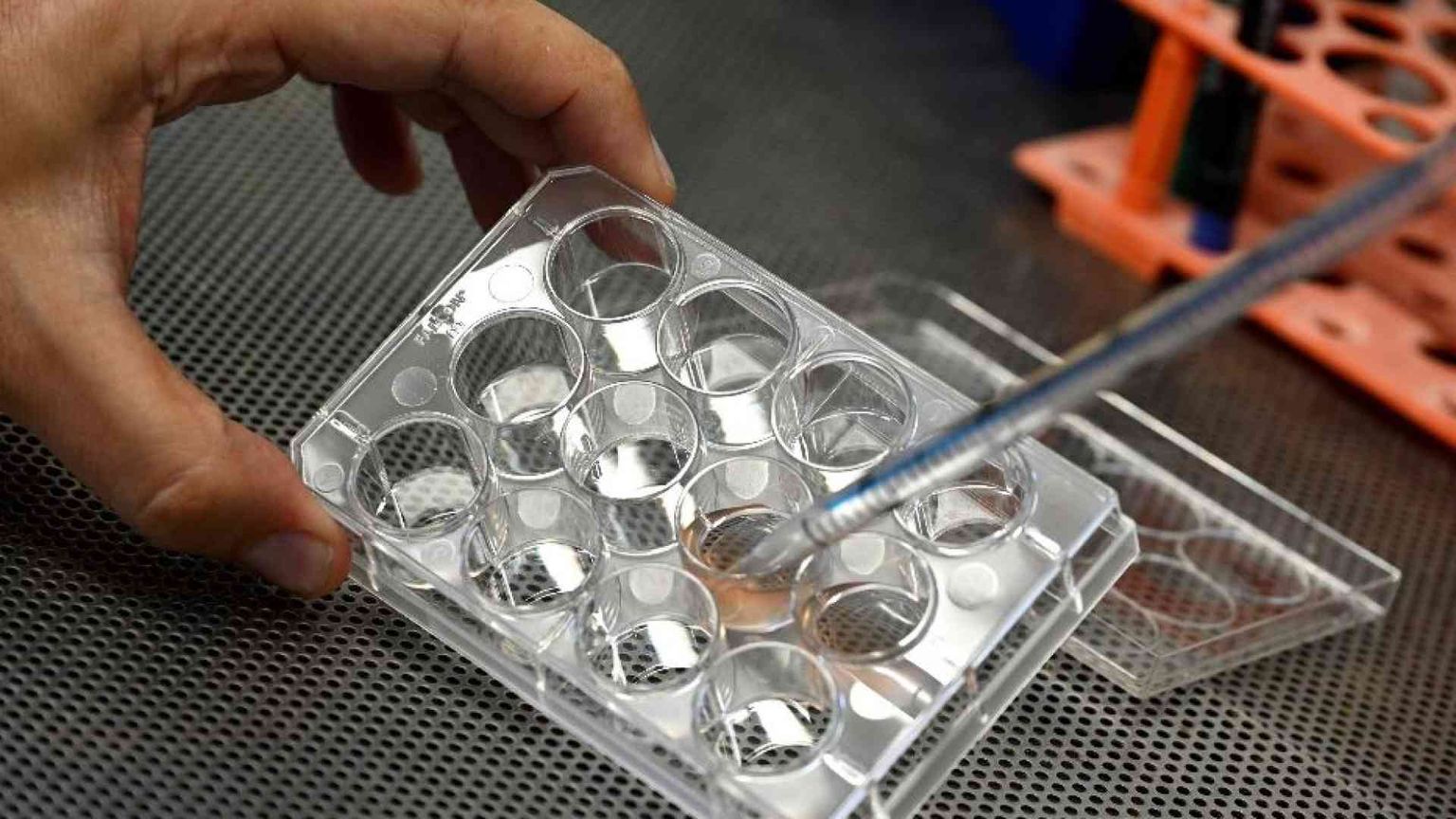 Sclerosi multipla, «risultati positivi» da trapianto di staminali nel cervello