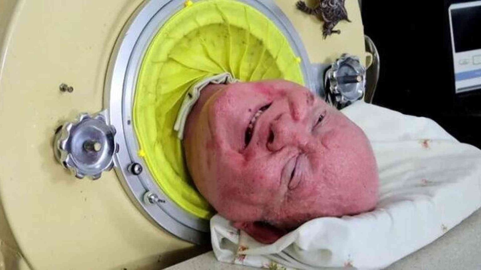 Addio a Paul Alexander, dopo 70 anni di «vita piena» in un polmone d'acciaio