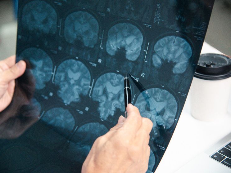 La nuova tecnologia di Rilemo: diagnosi di ictus in 5 secondi