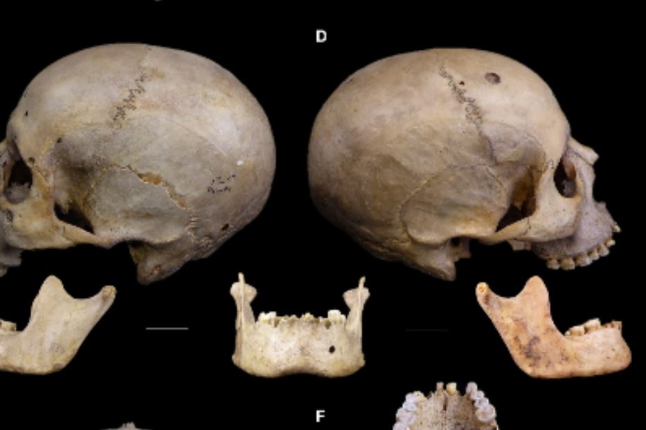 Il cranio operato di cancro nell'antico Egitto